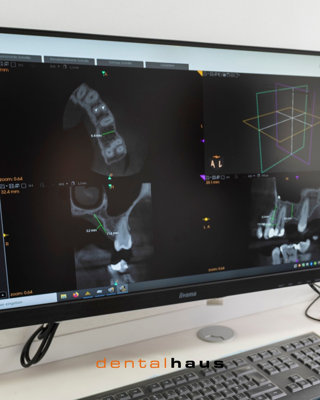 Mit modernster 3D-Technologie lassen sich Implantate präzise planen.
Jede Messung wird genau durchgeführt, um die Position und Passform optimal auf den einzelnen Patienten abzustimmen.
Dafür wird mithilfe eines digitalen 3D-Röntgenbildes (DVT – Digitale Volumentomographie) oder eines intraoralen Scans ein exaktes Abbild von Kiefer und Zähnen erstellt.
Diese Aufnahme zeigt Knochenstrukturen, Zahnwurzeln und Nervenverläufe in höchster Detailgenauigkeit.
So kann die Behandlung sicher, effizient und komfortabel durchgeführt werden, während ein bestmögliches ästhetisches und funktionales Ergebnis erzielt wird.
#Zahnmedizin #3DTechnologie #Implantatplanung #ModerneZahnmedizin #PraxisInnovation #GesundesLächeln #ZahnarztPraxis #Präzision #Patientenkomfort #Zahnimplantat #Forchheim #dentalhaus