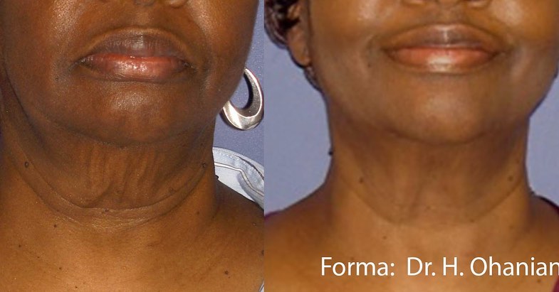 ??⚕️ Behandlung: Ästhetische Körperstraffung
? Technik: FORMA - Neueste medizinische Radiofrequenz Gesicht & Körperstraffung mit Temperaturmessung in Echtzeit für Maximale Ergebnisse by #inmodeaesthetics
✅glättet & strafft
✅verlangsamt den Hautalterungsprozess
✅verbessert die Hautelastizität
✅sämtliche Kollagenfasern in allen Schichten werden stimuliert
? Zonen: Gesicht, Hals, Dekolleté, Arme, Bauch, Knie
? Ergebnis: glatte, pralle, ebenmäßige Haut
⏰ Behandlungsdauer: 60 Minuten
? Preis: Gesicht/ Hals/ Dekolleté 190€
Terminvereinbarung
? 0162/ 1723052
? info@skinconcept-Hannover.de
? www.skinconcept-Hannover.de
?Ihr Premiumstandort für medizinische Kosmetik & Well-Aging in Hannover seit 2016
#formabyinmode #inmode #körperformunghannover #formahannover#körperstraffunghannover #inmodehannover #diodenlaserhannover #haarentfernunghannover #dauerhaftehaarentfernung #diolazexl #diolazexlinmode #laserhaarentfernunghannover #hannover #dauerhaftehaarentfernunghannover #hydrafacialhannover #bodyfxgermany #bodyfxhannover