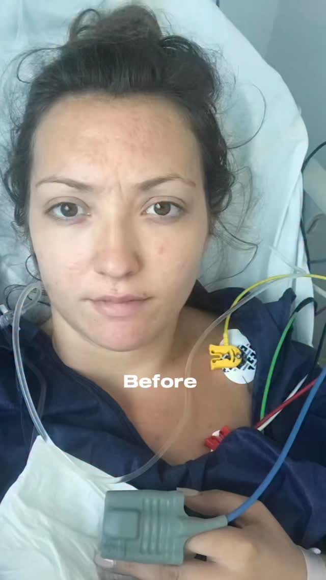 J’ai traversé les ténèbres.
Ma peau était en souffrance, tout comme moi.
Aujourd’hui, rien n’est “parfait”, et peut-être que ça ne le sera jamais complément mais j’ai quand même atteint un vrai confort de vie et tout ça semble derrière. Je ne souffre plus en bougeant la tête de gauche à droit car je n’ai pas une vingtaine de kystes dans la nuque, je ne souffre plus la nuit car je peux positionner ma tête comme je le veux sur l’oreiller, je ne souffre plus de pics de douleurs juste en m’asseyant sur une chaise, je peux porter des jeans alors qu’il y a 10 ans c’était impossible sans risquer un énième abcès dans l’aine. Et tout ça je le savoure +++
Ma peau reste dysfonctionnelle, atypique, hypersensible, que dis-je hyper réactive et elle sera toujours différente de celle des autres et j’apprends à vivre avec ça.
Grâce à la naturopathie, la micronutrition et une approche fonctionnelle et intégrative, j’ai réussi à adoucir mon quotidien alors qu’en 2019 j’ai frôlé deux fois la septicémie et ai manqué de mourir.
Je ne parle pas de miracle mais d’évolution. D’un chemin long et tortueux et à la fois de courage et de résilience. De mieux-être.
Et c’est déjà énorme.
Un clin d’œil particulier à tous ceux qui m’ont aidé sur le chemin depuis 2019 via des consultations toutes plus riches les unes que les autres @adrien.ruet_naturopathe @krotoum @francois_benavente_naturopathe @tiphaine.fontaine …
Je me suis entourée des meilleurs.
Et parce que mon histoire de peau est ce qu’elle est, j’ai eu envie de vous transmettre ce que j’ai appris.
J’ai rassemblé ma méthode dans un pack d’eBooks pour que vous aussi, vous puissiez améliorer votre peau, et en particulier votre acné.
Il passe de 42€ à 30€ pendant quelques jours ?
Commente acné afin de recevoir le lien automatique pour te l’offrir.
#peauatypique #naturopathie #skinjourney #acné #maladiedeverneuil #holistichealth #micronutrition #medecinefonctionnelle #maladiedepeau #maladiechronique
#avantapres #acnesevere #acneconglobata #guerison #remission