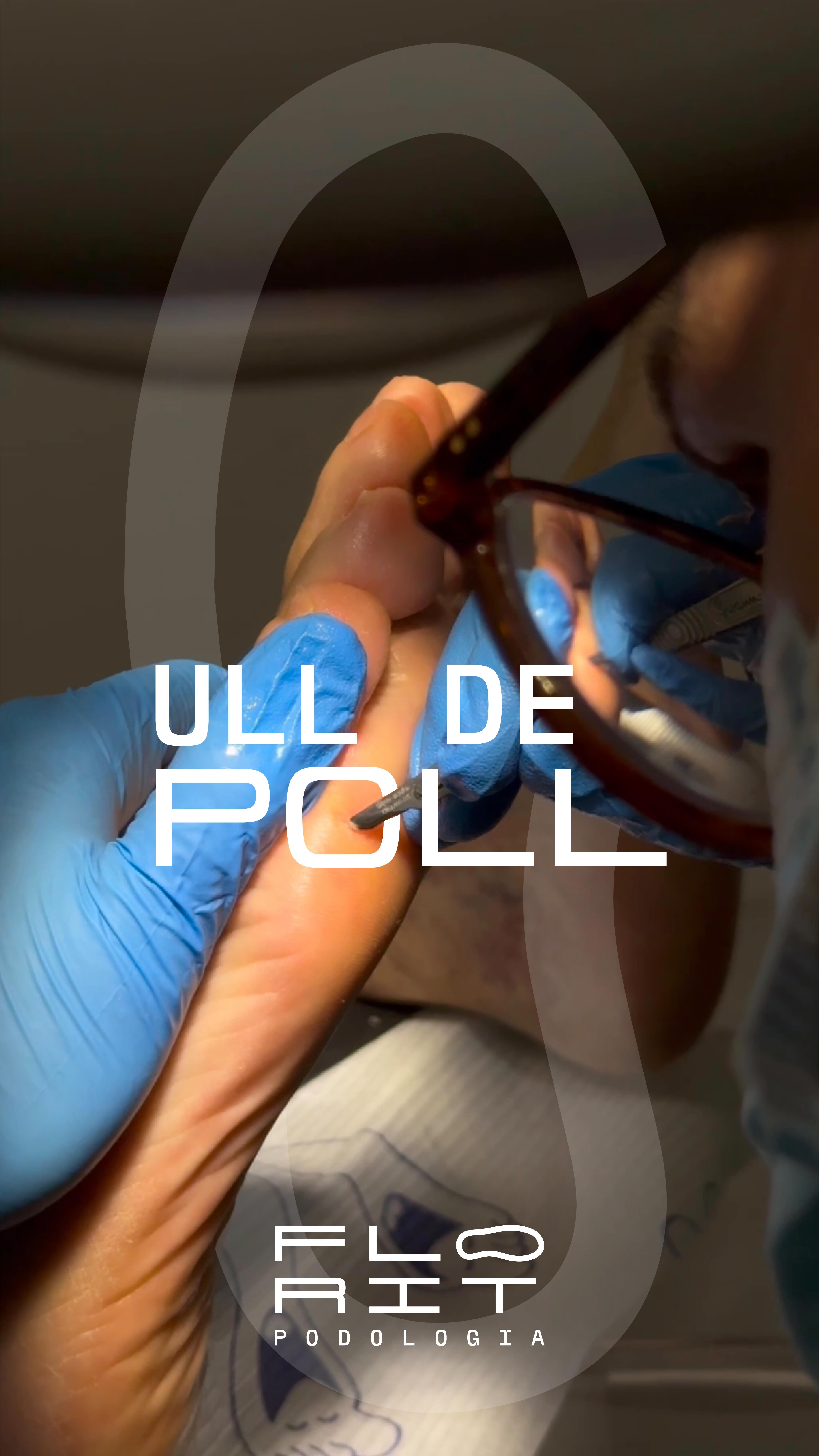 Esto es un Heloma Plantar (o como solemos llamarlo aquí en Menorca, un “ull de poll” ?️?).
Es un callo profundo que aparece por la hiperpresión en una zona del pie, y se siente como si llevaras una chincheta ? clavada. ¡Muy molesto y doloroso! ?
Pero no debes preocuparte, porque en nuestra clínica te lo tratamos al momento, de forma rápida e indolora, para que salgas caminando cómodamente. ?✨
Si este es tu caso, contáctanos y encontraremos la solución para ti. ?? Contigo, para que sigas dejando huella. ?
#clinica #florit #podologia #heloma #plantar #callo #dolor #molestia #intervención #tratamiento #salud #pies #comodidad #mahon #menorca