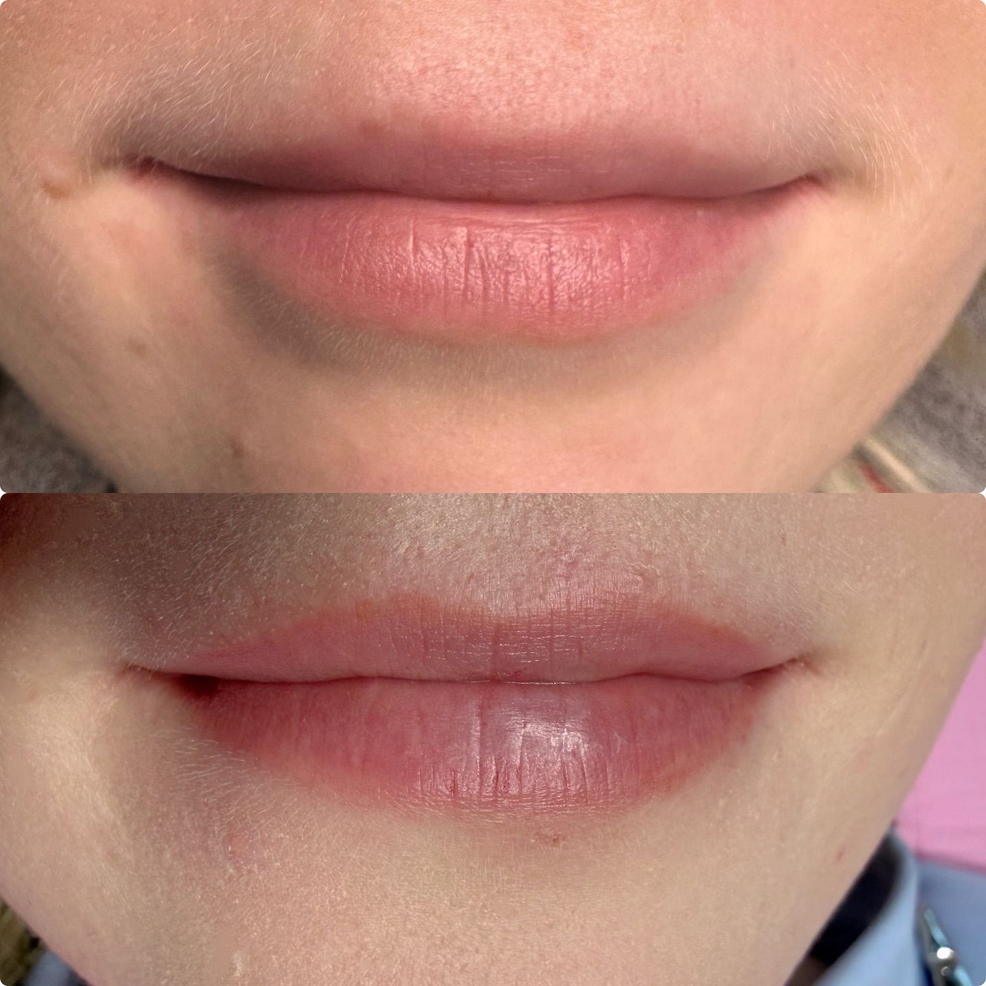 ? Lippenpigmentierung – was passiert bei der Abheilung? ?
Hey Ladies,
viele haben Respekt vor dem Thema Abheilung nach einer Lippenpigmentierung – und genau da möchte ich dir die Angst nehmen. ✨
? Direkt nach der Behandlung wirken die Lippen oft intensiver, als sie später aussehen. Keine Sorge: Das ist völlig normal. In den ersten Tagen kann es zu leichten Schwellungen oder kleinen Krusten kommen – das gehört zum Heilungsprozess dazu.
? So läuft die Abheilung ab:
1️⃣ Tag 1–3: Deine Lippen sind kräftiger in der Farbe, manchmal auch etwas dunkler.
2️⃣ Tag 3–7: Leichte Krustenbildung und Abschuppen. Wichtig: nicht pulen! ?♀️
3️⃣ Tag 7–14: Die Farbe wirkt deutlich heller, fast so, als wäre sie verschwunden.
4️⃣ Ab Woche 3: Die Pigmente kommen zurück und die Lippen wirken gleichmäßig und natürlich.
Nach ca. 4–6 Wochen ist das Ergebnis sichtbar – und du hast volle, frische Lippen, die wie zart geschminkt aussehen. ?
✨ Mein Tipp: Pflege deine Lippen in dieser Zeit sanft, verzichte auf stark gewürzte Speisen und viel Sonne, und halte dich an die Pflegehinweise. So unterstützt du die Heilung optimal.
Viele meiner Kundinnen sagen: „Ich dachte, das sieht schlimmer aus – aber es war absolut entspannt.“ Und genau so soll es sein. ?
? Dandelion | Cosmetic Studio Potsdam
? Schreib mir gerne, wenn du Fragen hast – ich begleite dich durch den ganzen Prozess.
#lipblush #lipblushtattoo #lipblushhealed #lipblushtraining #pmu