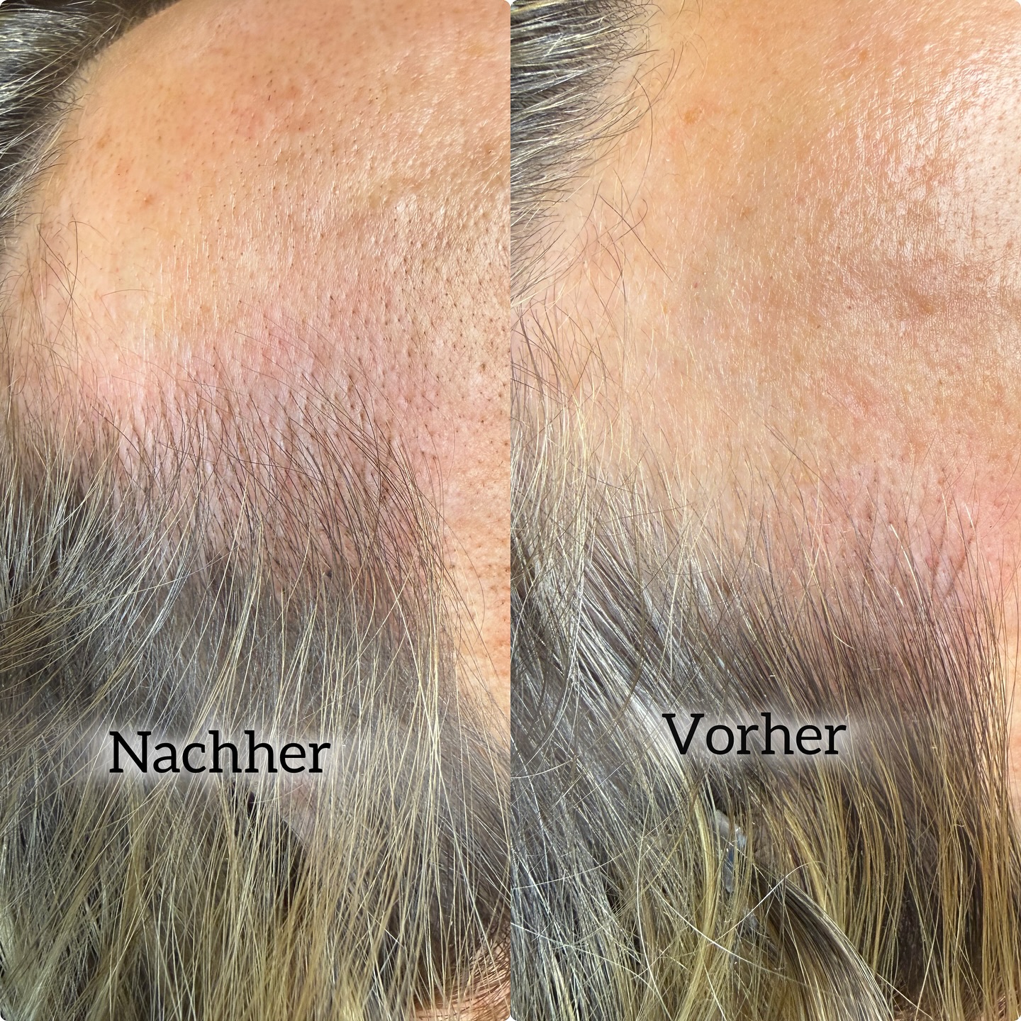 Ihr Lieben ?
ich zeige euch ständig Brows, Lips & Haut – aber was viele wirklich nicht wissen:
Ich mache seit Jahren Haarpigmentierung und Hair-Strokes an Haaransatz & Kopfhaut.
Ich rede nur selten darüber, aber ich arbeite seit sehr langer Zeit mit dieser Technik – bei Männern UND Frauen.
Und genau das seht ihr hier:
Bei dieser Behandlung habe ich feine Härchen-Striche zwischen die eigenen Haare gesetzt, um den Haaransatz optisch zu verdichten.
Kein Punkt-Look, keine Schattierung – echte Hair-Strokes, die aussehen wie natürliche, einzelne Haare.
Was ich hier konkret gemacht habe:
✅ Lücken am vorderen Haaransatz geschlossen
✅ Strichrichtung an die natürliche Wuchsrichtung angepasst
✅ Farbmischung exakt auf den Haarton abgestimmt
✅ Übergänge weicher gestaltet, damit der Haaransatz wieder harmonisch wirkt
✅ Gesamtbild optisch „gefüllt“, aber trotzdem superfein und natürlich gehalten
Und ja – ich behandle nicht nur Männer, die nach einer Haartransplantation eine saubere, klare Linie wollen oder Geheimratsecken kaschieren möchten.
Viele meiner Kundinnen kommen zu mir, weil sie durch Stress, Hormone oder natürliche Ausdünnung kleine Lücken haben und sich wieder mehr Dichte wünschen. ✨
Ich liebe diese Arbeit – weil sie unauffällig ist, aber sofort einen riesigen Unterschied macht.
Man sieht nicht „Pigmentierung“. Man sieht einfach nur ein Haarbild, das wieder ruhiger, voller und stimmiger wirkt.
Wenn du dich hier wiedererkennst – egal ob Mann oder Frau:
? kurze Beratung
? direkt im Anschluss startklar
? keine Ausfallzeit
? Ergebnis ab der ersten Sitzung sichtbar
Termine könnt ihr wie immer online buchen.
Ich freue mich auf euch. ?✨
Eure Rebekka
Dandelion | Cosmetic Studio
Charlottenstraße 92/93 · Potsdam
#haarpigmentierung #hairstrokes #hairline #hairdensity #scalpmicropigmentation #haarpigmentierungfrauen #haarpigmentierungmänner #hairfill #haarausfalllösung #hairtattoo #smp #pmuart #dandelioncosmeticstudio #dandelionpotsdam #hairrestoration #hairlinecorrection #micropigmentation #hairenhancement #naturallook #hair
