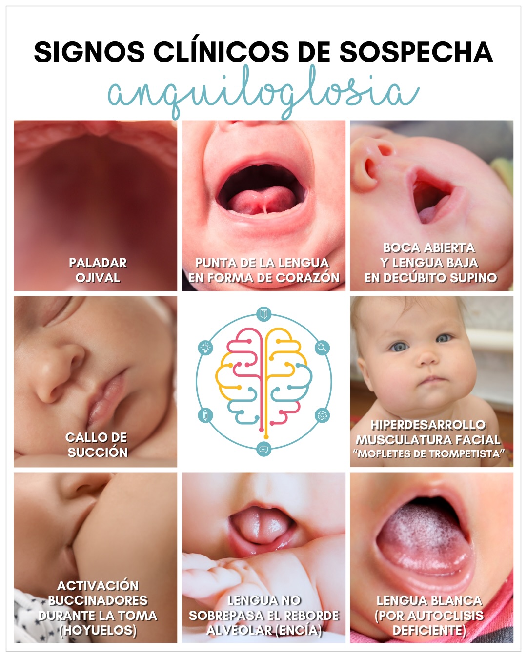 El frenillo lingual es un pliegue mucoso que une la cara ventral de la lengua al suelo de la boca. Cuando se desarrolla de forma anómala causando dificultades funcionales hablamos de anquiloglosia. Esta anomalía congénita podría limitar la función de la lengua y por tanto puede dificultar el amamantamiento y la correcta nutrición del bebé.
Hoy te mostramos algunos de los signos clínicos que puede incluir esta condición. Es importante destacar que existen otros signos relacionados con la presencia de anquiloglosia como pueden ser las dificultades en el habla, problemas dentales o, también, los signos relacionados con las dificultades en la lactancia, ¿los conoces?
La docente que trata al detalle este tema en nuestra formación “Experto/a en Asesoría y Consejería en Lactancia Materna para profesionales sanitarios” es la Dra. Yaiza Cuba @dra_cuentadientes, odontopediatra e IBCLC con una gran experiencia clínica.
? Todo esto y mucho más se aborda en nuestro completo curso de Experto/a en Asesoría y Consejería en Lactancia Materna para profesionales sanitarios, actividad académica avalada por la Federación Española de Sociedades de Nutrición, Alimentación y Dietética (FESNAD), 100% online y de 3 meses de duración.
‼️Empezamos el 12 de Enero‼️
? PROMOCIÓN BLACK FRIDAY (-200€)‼️
Valida hasta el 7 de diciembre de 2025
ℹ️ Las plazas son limitadas y se asignarán por orden de inscripción.
✉️ Más info en info@isnut.es, www.isnut.es y en el link de nuestra BIO.
#isnut #isnutformaciones #formacionesquenutren #formaciononline #lactanciamaterna formacionlactancia asesoradelactancia consejeradelactancia