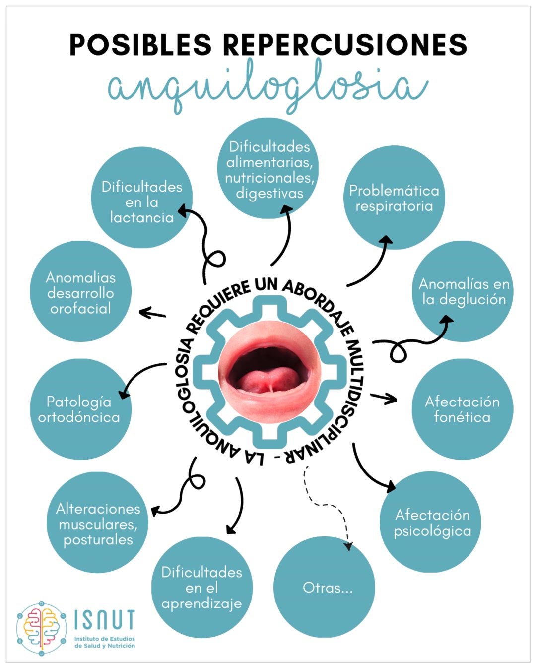 Cuando el frenillo lingual se presenta anatómicamente alterado y/o disfuncional hablamos de anquiloglosia. Esta condición puede afectar a las funciones orales del bebé y por tanto tener repercusiones no solo en la succión del pecho, sino en su desarrollo orofacial y sistémico a medio y largo plazo, predisponiendo al pequeño a diversas dificultades y afectaciones en la salud.
El abordaje multidisciplinario es fundamental y por ello es esencial que la formación de profesionales sanitarios sea transversal en todas las áreas según el impacto que tengan en el diagnóstico, tratamiento y abordaje de sus posibles complicaciones.
Hoy, te presentamos algunas de las posibles repercusiones asociadas a la Anquiloglosia.
? Todo esto y mucho más se aborda en nuestro Curso Universitario ESPECIALIZACIÓN EN ANQUILOGLOSIA EN EL PACIENTE PEDIÁTRICO, título propio de la UEMC, 100% online, de 3 meses de duración y acreditado con 12 ECTS.
?️ Inicio: 23 de Marzo de 2026
? Promoción activa con descuento (-200€)‼️
⏳Duración: 3 meses (+3 meses extra)
Es tu momento, ESPECIALÍZATE ✨
ℹ️ Más información: info@isnut.es, en link de nuestra bio y en www.isnut.es ?
‼️TE ESPERAMOS‼️
#isnut #isnutformaciones #formacionesquenutren #formaciononline #anquiloglosia