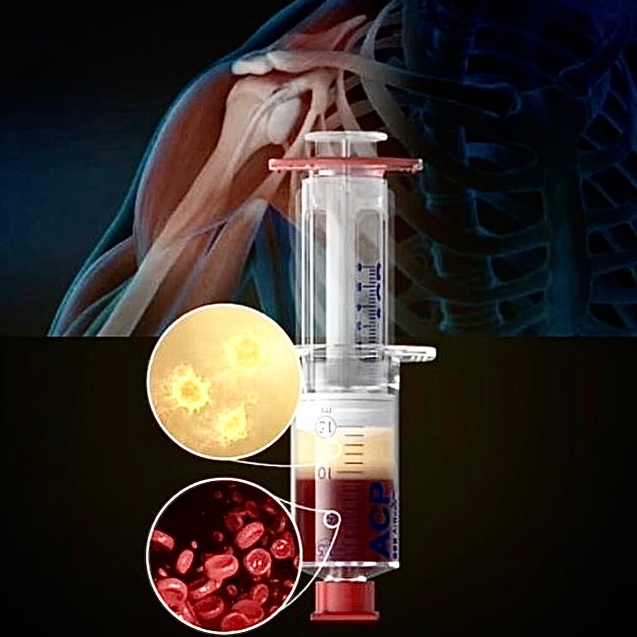 Plasmatherapie bei Schulterarthrose.
Wir beraten sie gerne.
Ihr Praxisteam
Dangalis
#praxis